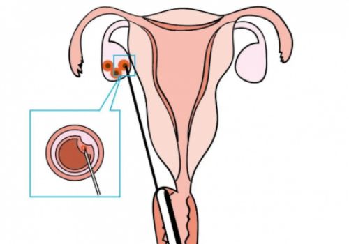 2022女性患有宫腔粘连做试管婴儿能够成功吗？